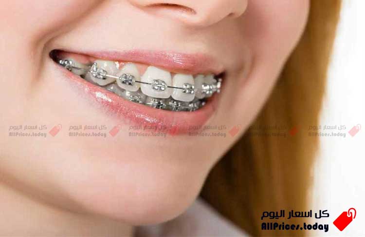 اسعار تقويم الأسنان في مصر