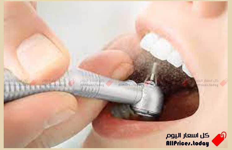 أسعار حشو الأسنان في السعودية